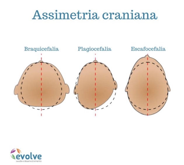 Exemplo de assimetria craniana em bebê